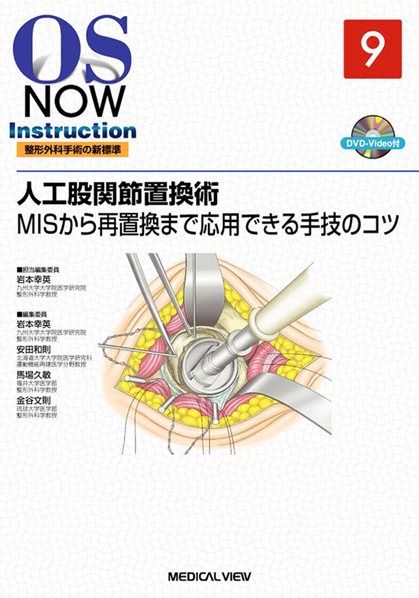 人工股関節置換術