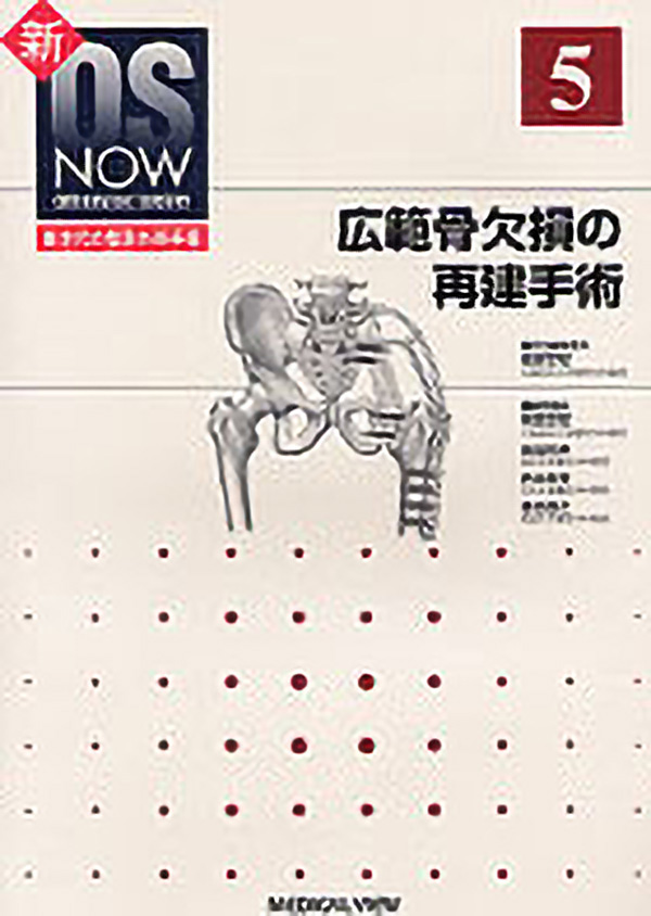 広範骨欠損の再建手術
