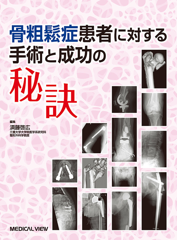 骨粗鬆症患者に対する手術と成功の秘訣 ／ メジカルビュー社-